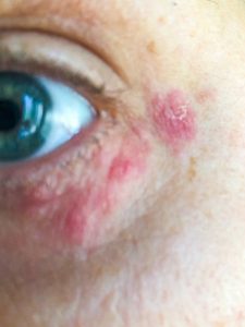 Eczema is an unpleasant symptom of Dust Mites